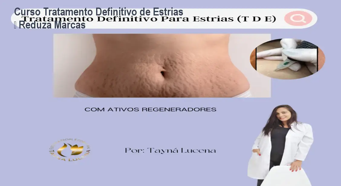 Curso Tratamento Definitivo de Estrias – Reduza Marcas 1 Curso Tratamento Definitivo de Estrias – Reduza Marcas